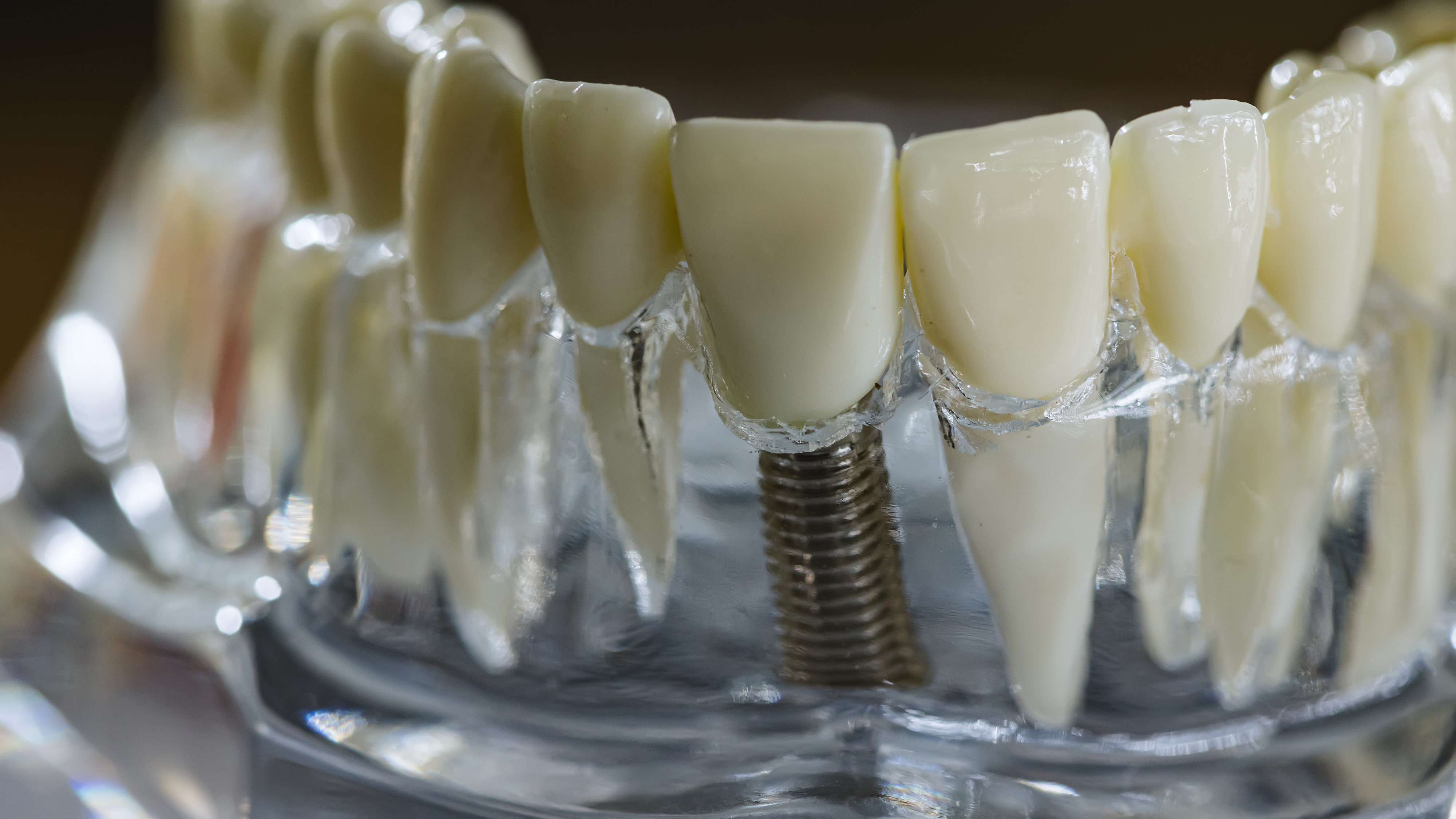 Implantes Dentários em Florianópolis - Solução definitiva para perda de dentes